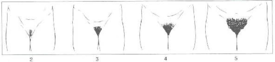 Figure 2. Stades pubertaires du développement du système pileux pubien de la fille