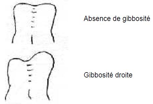 Figure II. Examen à la recherche d’une scoliose